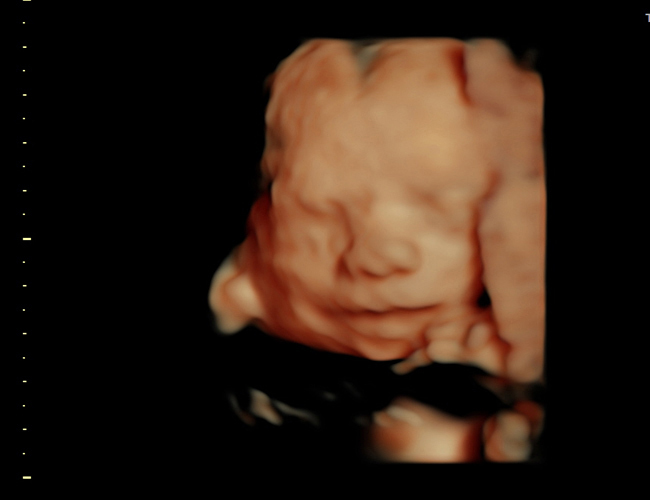 3D ultrasound image at 25 weeks